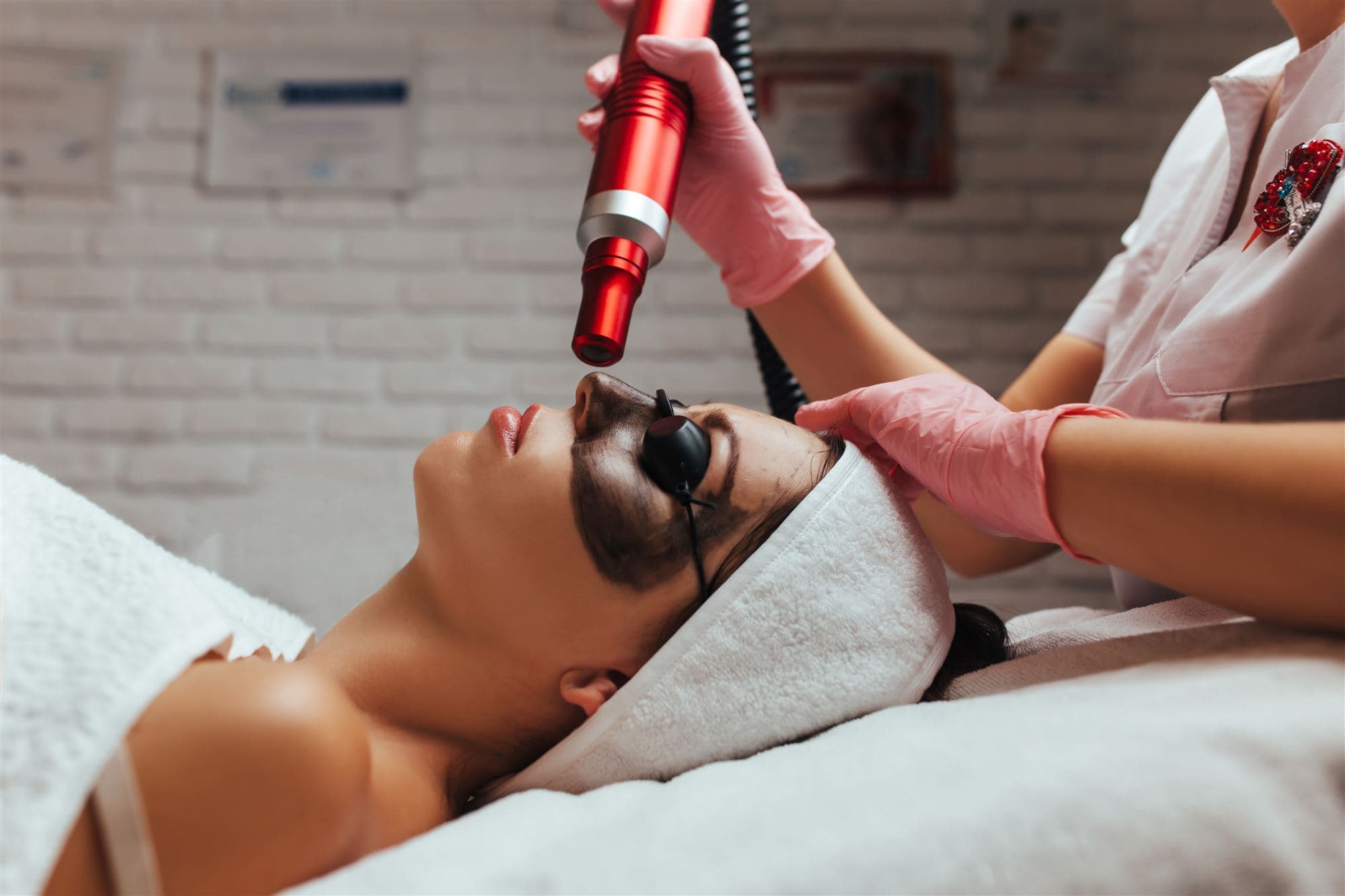 Hollywood Charcoal Peel in progress: black carbon mask, eye shields, and the carbon laser handpiece